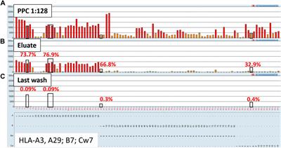 Cutting through the weeds: Evaluation of a novel adsorption with crossmatch cells and elution protocol to sharpen HLA antibody identification by the single antigen bead assay